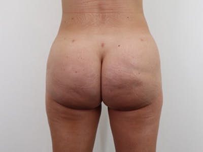 Brazilian Butt Lift Before & After Gallery - Patient 87551776 - Image 2