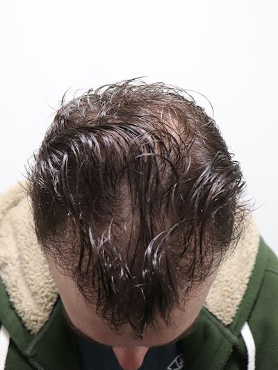Hair Restoration Before & After Gallery - Patient 87551774 - Image 2