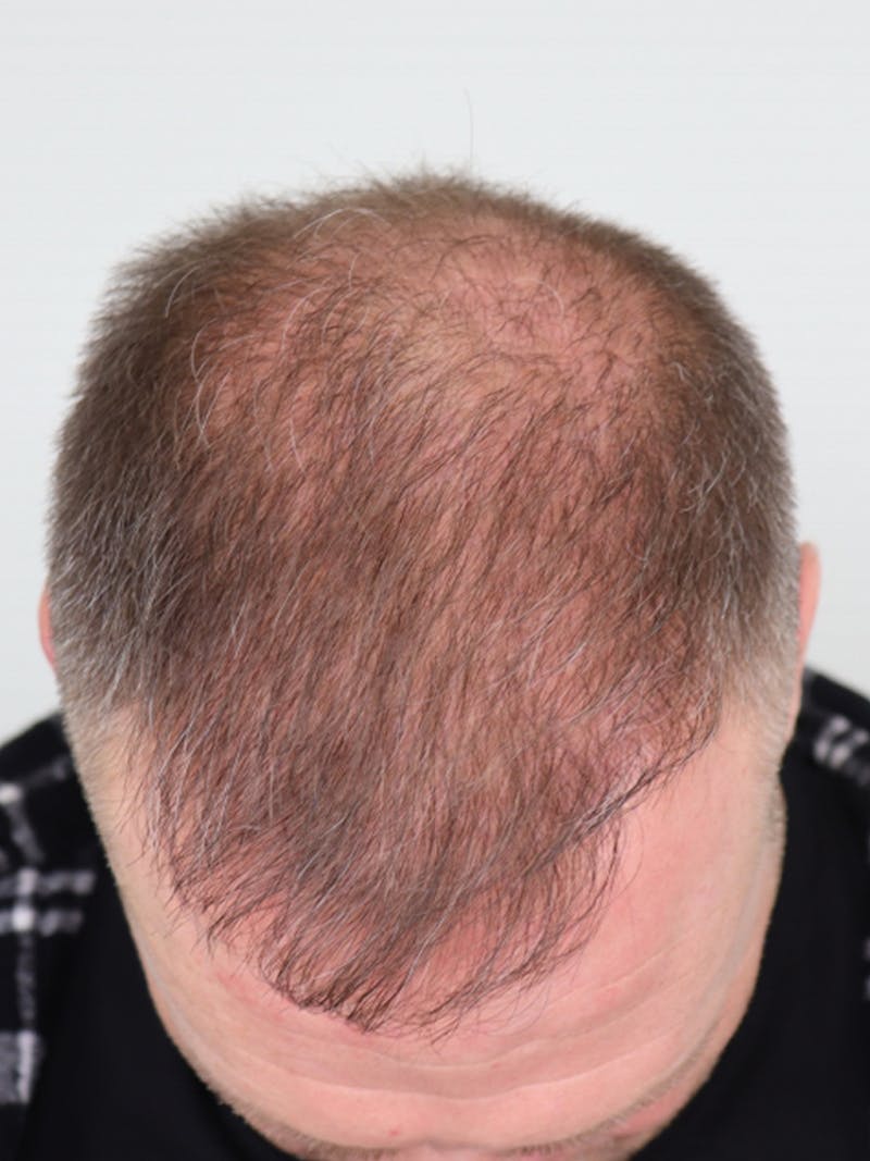 Hair Restoration Before & After Gallery - Patient 87551789 - Image 1