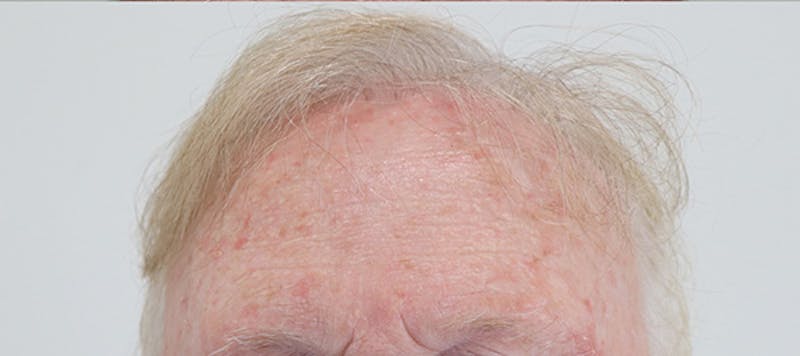 Neograft Before & After Gallery - Patient 87551777 - Image 6