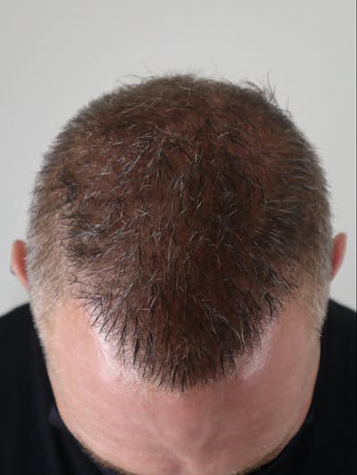 Hair Restoration Before & After Gallery - Patient 87551789 - Image 2