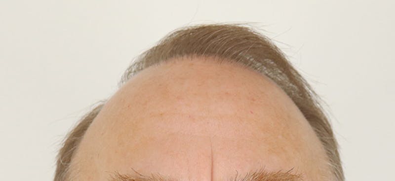 Neograft Before & After Gallery - Patient 87551779 - Image 1