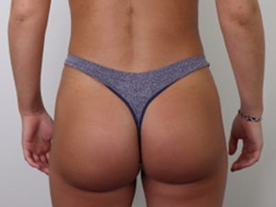 Brazilian Butt Lift Before & After Gallery - Patient 87551782 - Image 2