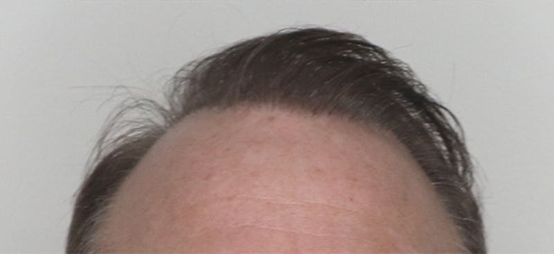 Neograft Before & After Gallery - Patient 87551779 - Image 2