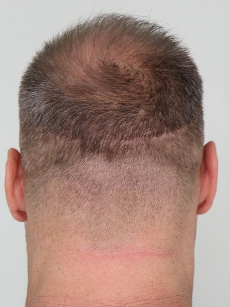 Hair Restoration Before & After Gallery - Patient 87551789 - Image 3