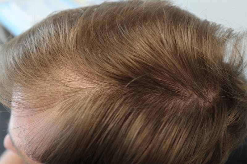 PRP for Hair Before & After Gallery - Patient 87551801 - Image 1
