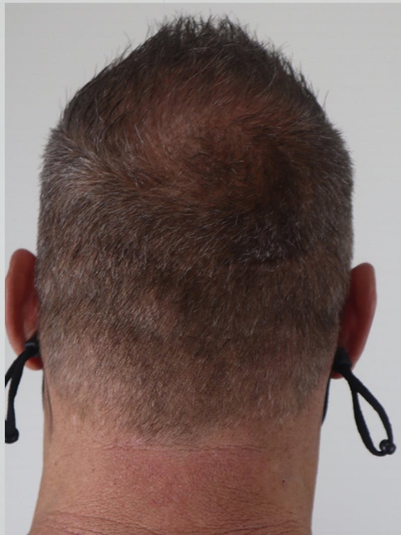 Hair Restoration Before & After Gallery - Patient 87551789 - Image 4