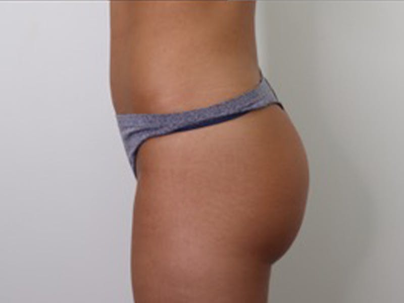 Brazilian Butt Lift Before & After Gallery - Patient 87551782 - Image 4