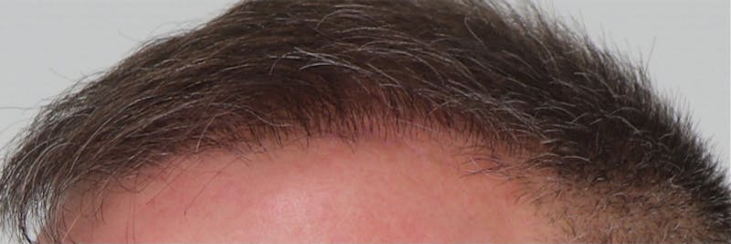 Hair Restoration Before & After Gallery - Patient 87551789 - Image 5