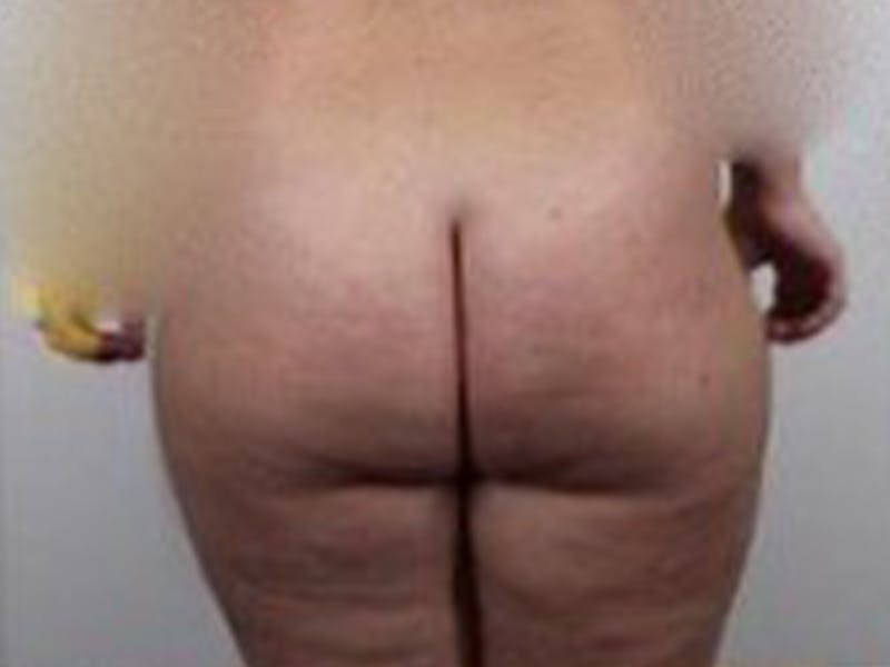 Brazilian Butt Lift Before & After Gallery - Patient 87551791 - Image 1