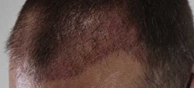 Neograft Before & After Gallery - Patient 87551804 - Image 2