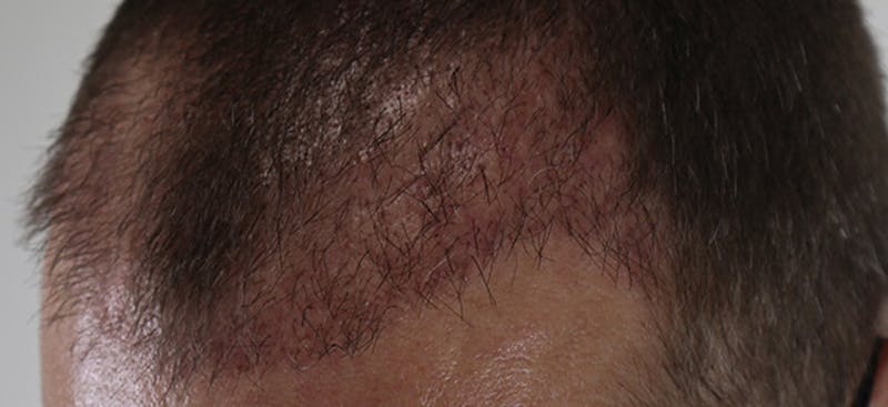 Neograft Before & After Gallery - Patient 87551804 - Image 2