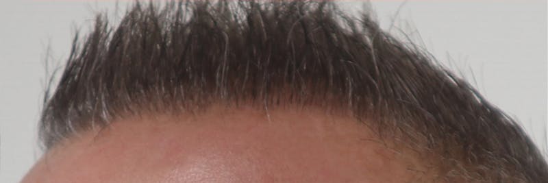Hair Restoration Before & After Gallery - Patient 87551789 - Image 6