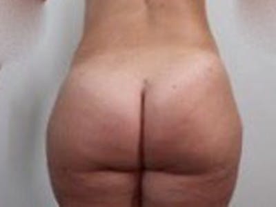 Brazilian Butt Lift Before & After Gallery - Patient 87551791 - Image 2