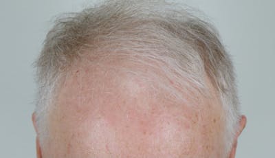 Hair Restoration Before & After Gallery - Patient 87551797 - Image 1