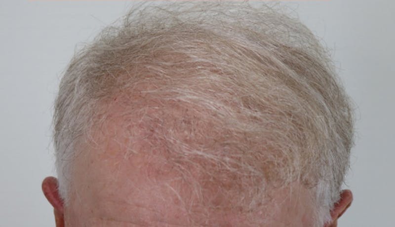 Hair Restoration Before & After Gallery - Patient 87551797 - Image 2