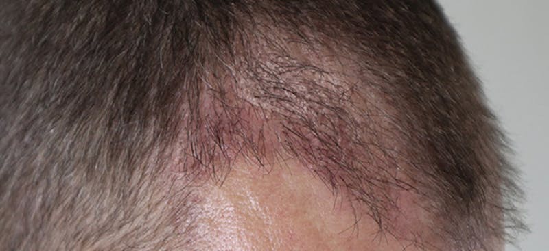 Neograft Before & After Gallery - Patient 87551804 - Image 6