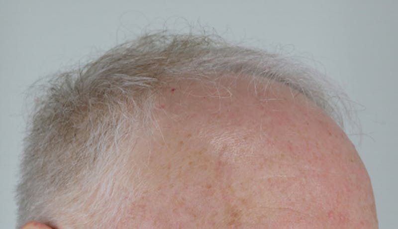 Hair Restoration Before & After Gallery - Patient 87551797 - Image 3