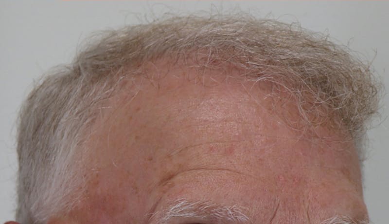 Hair Restoration Before & After Gallery - Patient 87551797 - Image 4