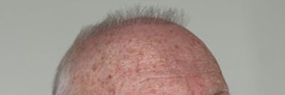 Hair Restoration Before & After Gallery - Patient 87551803 - Image 1