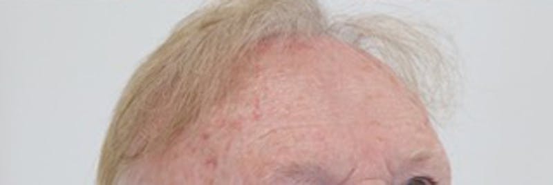 Hair Restoration Before & After Gallery - Patient 87551803 - Image 2