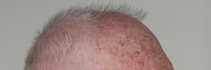 Hair Restoration Before & After Gallery - Patient 87551803 - Image 3