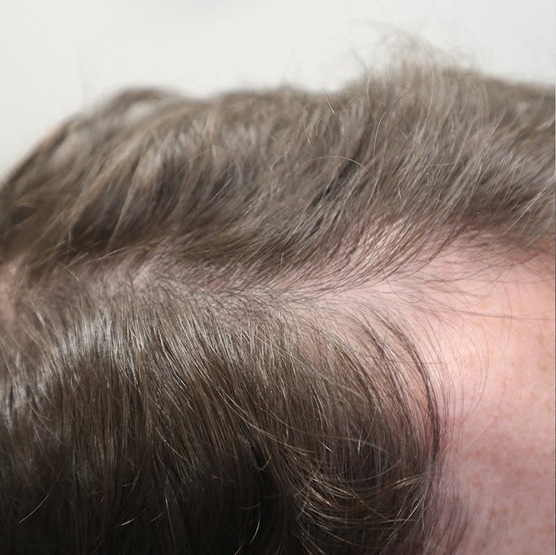 PRP for Hair Before & After Gallery - Patient 87551821 - Image 1