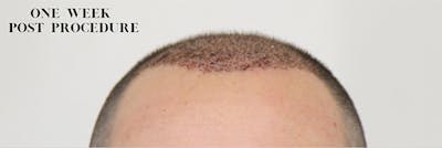 Hair Restoration Before & After Gallery - Patient 87551809 - Image 1