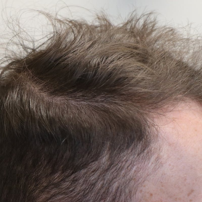 PRP for Hair Before & After Gallery - Patient 87551821 - Image 2