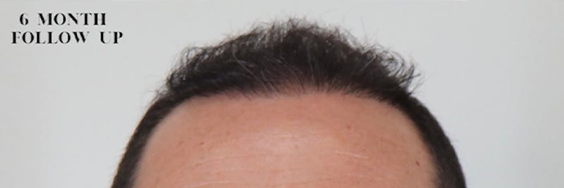 Hair Restoration Before & After Gallery - Patient 87551809 - Image 2