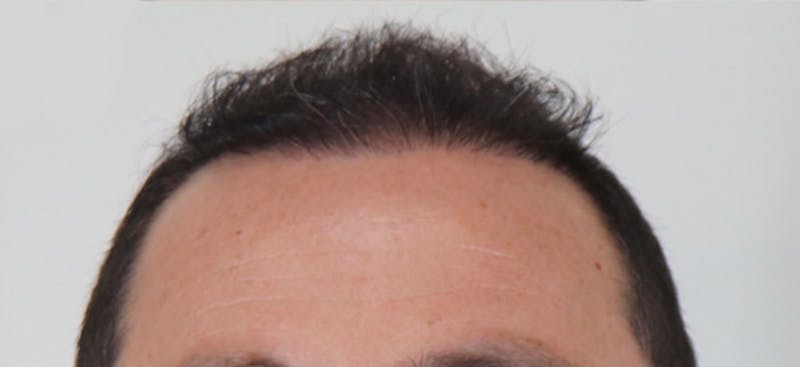 Neograft Before & After Gallery - Patient 87551815 - Image 2