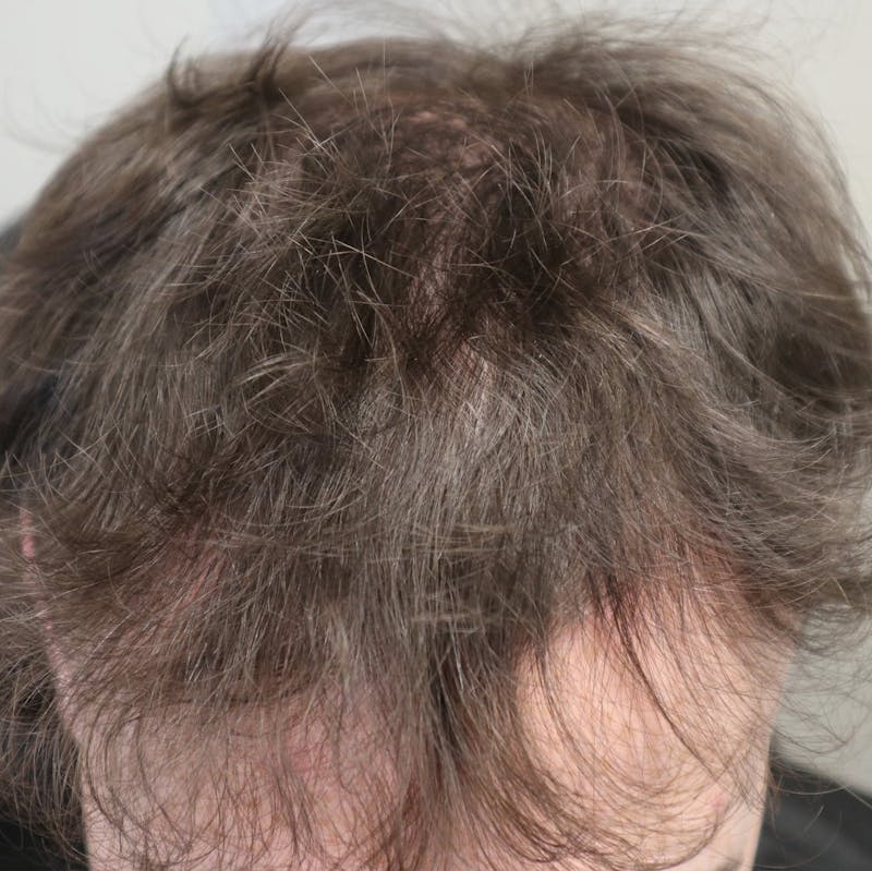 PRP for Hair Before & After Gallery - Patient 87551821 - Image 3