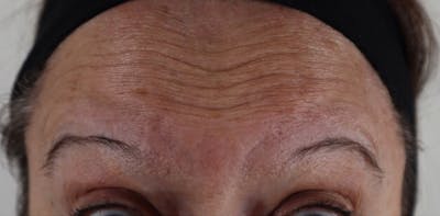 BOTOX Before & After Gallery - Patient 87551810 - Image 1