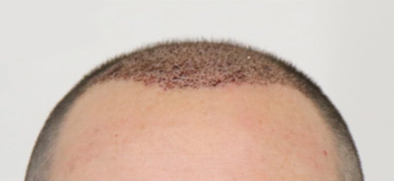 Neograft Before & After Gallery - Patient 87551815 - Image 3