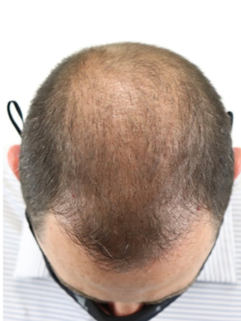 Hair Restoration Before & After Gallery - Patient 87551813 - Image 1