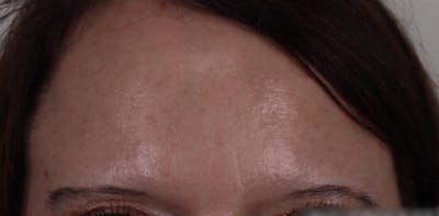 BOTOX Before & After Gallery - Patient 87551810 - Image 2