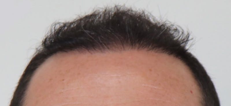 Neograft Before & After Gallery - Patient 87551815 - Image 4