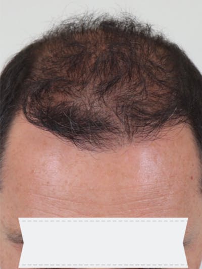 Hair Restoration Before & After Gallery - Patient 87551813 - Image 2