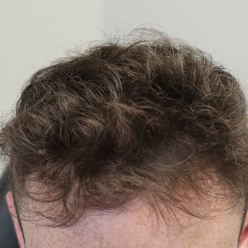 PRP for Hair Before & After Gallery - Patient 87551821 - Image 4