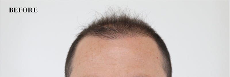 Hair Restoration Before & After Gallery - Patient 87551817 - Image 1