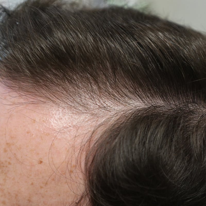 PRP for Hair Before & After Gallery - Patient 87551821 - Image 5