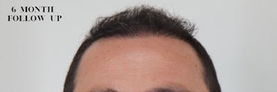 Hair Restoration Before & After Gallery - Patient 87551817 - Image 2