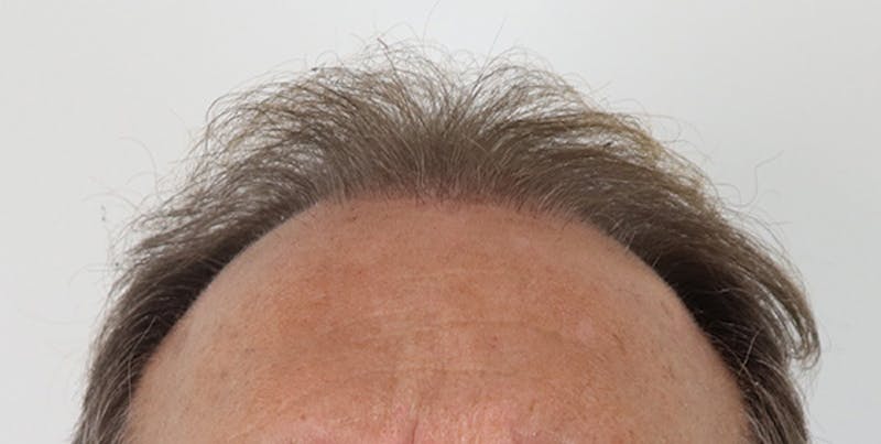 Neograft Before & After Gallery - Patient 87551828 - Image 1