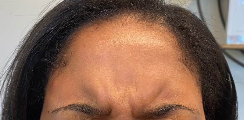 BOTOX Before & After Gallery - Patient 87551823 - Image 3