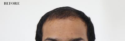 Hair Restoration Before & After Gallery - Patient 87551822 - Image 1