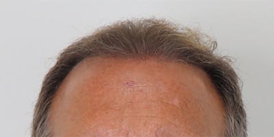 Neograft Before & After Gallery - Patient 87551828 - Image 2
