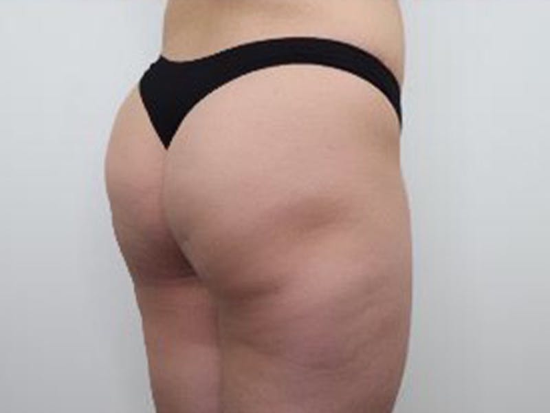 Brazilian Butt Lift Before & After Gallery - Patient 87551820 - Image 4