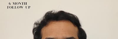 Hair Restoration Before & After Gallery - Patient 87551822 - Image 2