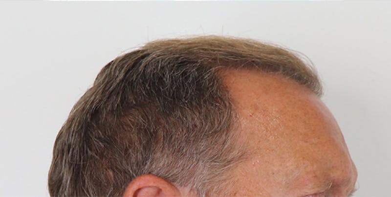 Neograft Before & After Gallery - Patient 87551828 - Image 4