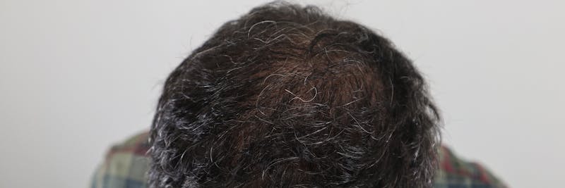 PRP for Hair Before & After Gallery - Patient 87551829 - Image 1